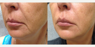 Dermal Fillers before and after photo