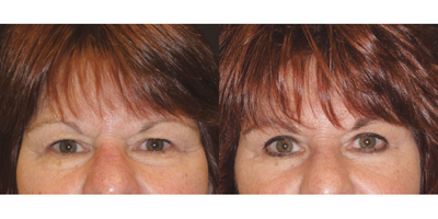 Eyelid Surgery before and after photo