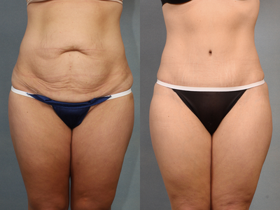 Tummy Tuck before and after photo