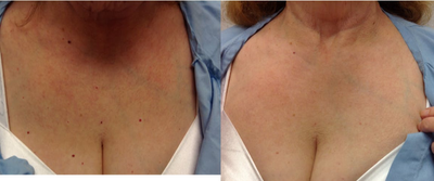 Vbeam before and after photo
