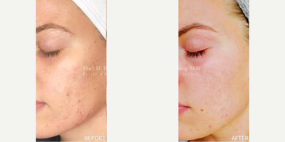 Chemical Peel before and after photo