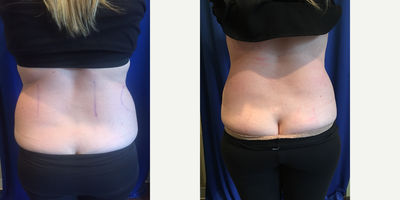 CoolSculpting before and after photo