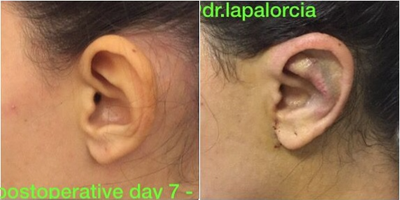 Ear Surgery before and after photo