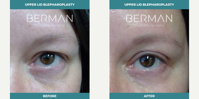 Eyelid Surgery before and after photo