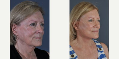 Facial Fat Transfer before and after photo