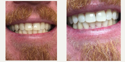 Teeth Whitening before and after photo