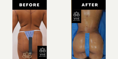 Brazilian Butt Lift before and after photo