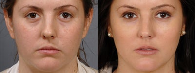Cheek Augmentation before and after photo