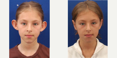 Ear Surgery before and after photo