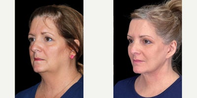 Eyelid Surgery before and after photo