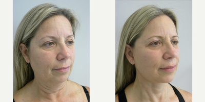 Facelift before and after photo