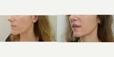 Lip Lift before and after photo