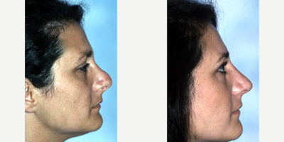 Revision Rhinoplasty before and after photo