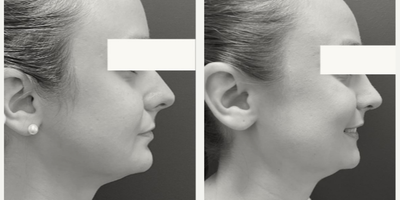 Rhinoplasty before and after photo
