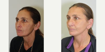 Rhinoplasty before and after photo