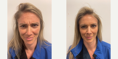 Botox before and after photo