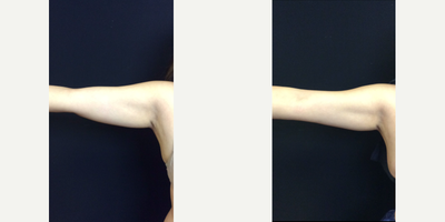 CoolSculpting before and after photo