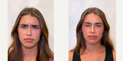 Dysport before and after photo