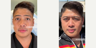 Facial before and after photo