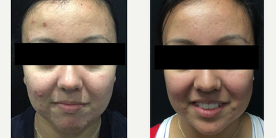 Chemical Peel before and after photo