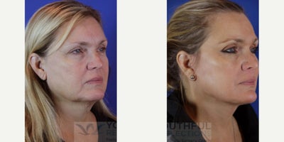 Facial Fat Transfer before and after photo