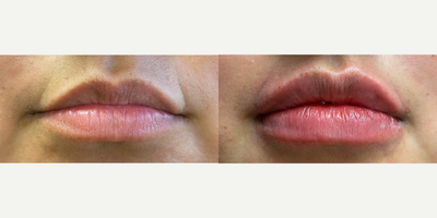 Juvederm before and after photo