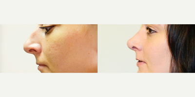Rhinoplasty before and after photo