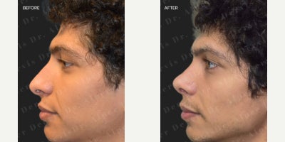 Rhinoplasty before and after photo