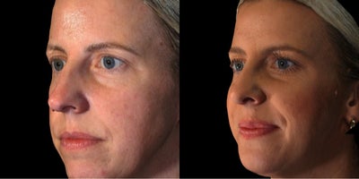 Rhinoplasty before and after photo