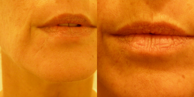 Affirm Laser before and after photo