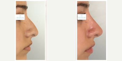 Bellafill before and after photo
