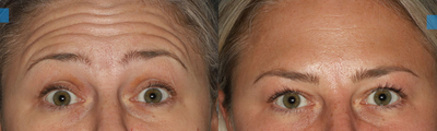 Botox before and after photo