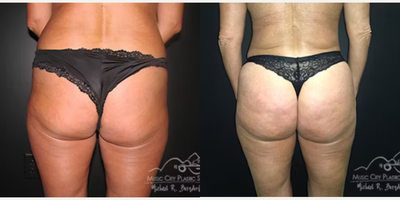 Brazilian Butt Lift before and after photo