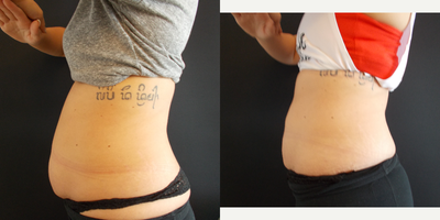 CoolSculpting before and after photo