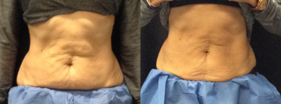 CoolSculpting before and after photo