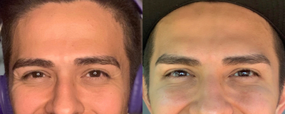 Botox before and after photo
