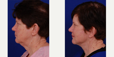 Facelift before and after photo