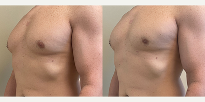 Gynecomastia Surgery before and after photo