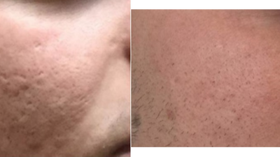 Microneedling before and after photo