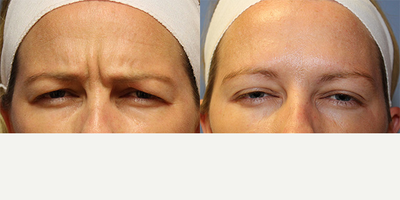 Botox before and after photo