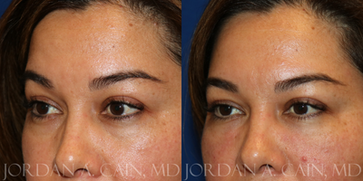 Dermal Fillers before and after photo
