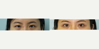 Double Eyelid Surgery before and after photo
