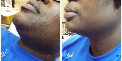 Laser Hair Removal before and after photo