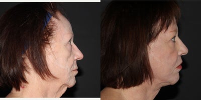 Lip Lift before and after photo