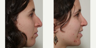 Rhinoplasty before and after photo