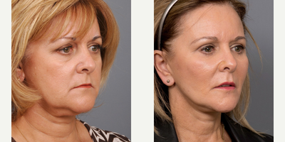 SMAS Facelift before and after photo