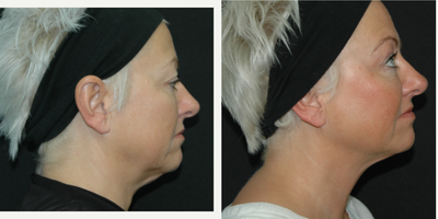Ultherapy before and after photo