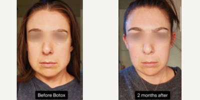 Botox for TMJ before and after photo