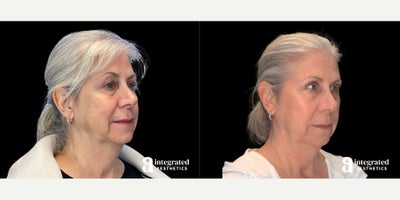 Botox before and after photo
