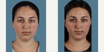 Chin Filler before and after photo